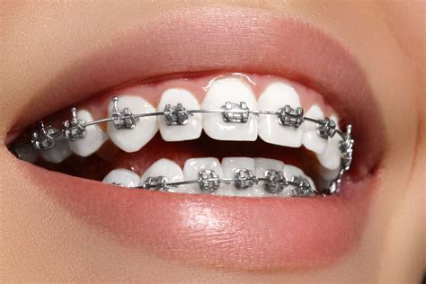 precios brackets metalicos y esteticos|brackets metalicos.